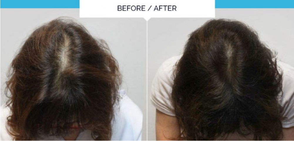 Hair Regrowth Treatment | Aeterna Health